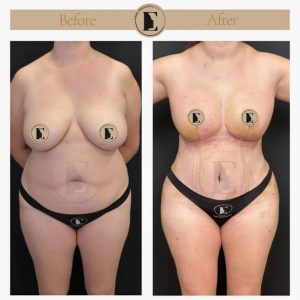 imgi_38_mommy-makeover-in-turkey-before-after-07-1024x1024.jpeg