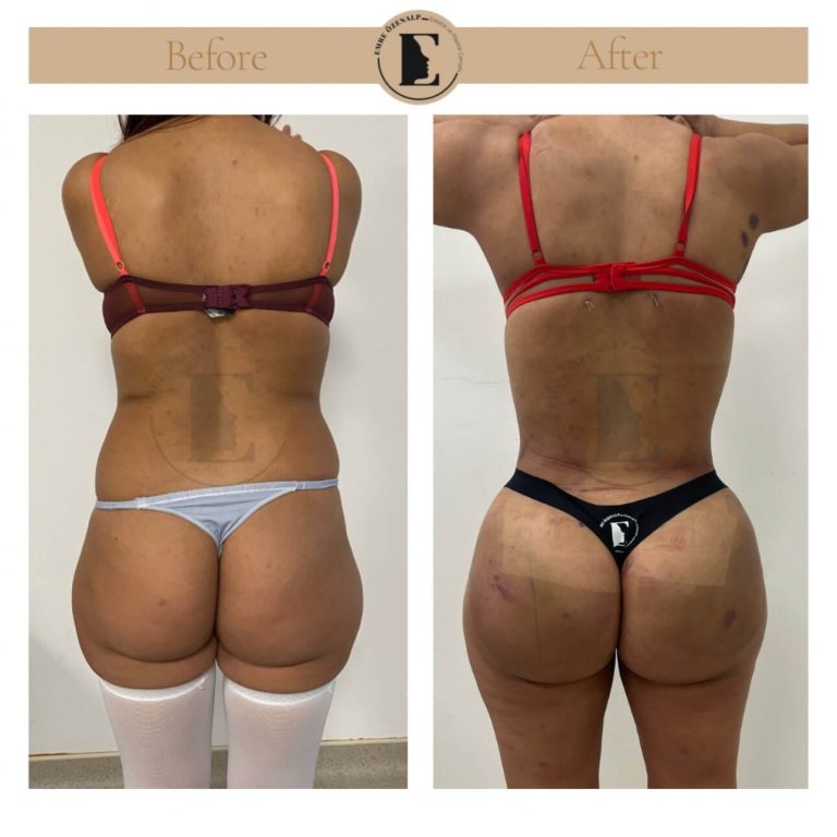 imgi_39_BBL-before-after-in-Turkey-21