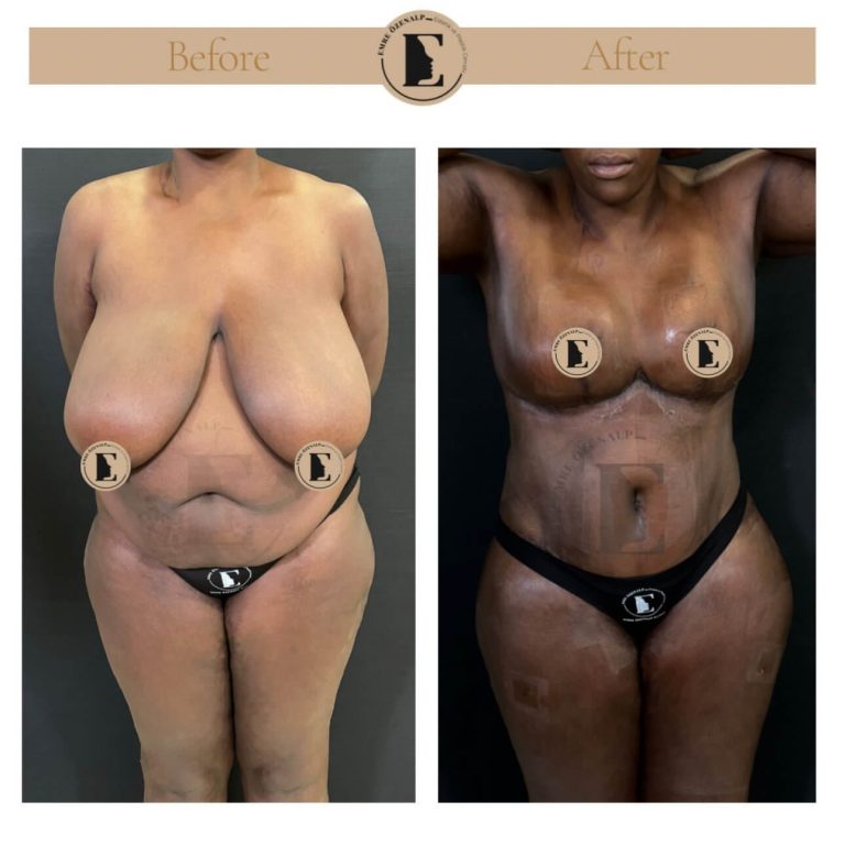 imgi_39_boob-reduction-in-turkey-before-after-04