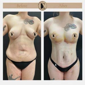 imgi_39_mommy-makeover-in-turkey-before-after-06-1024x1024.jpeg