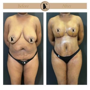 imgi_40_mommy-makeover-in-turkey-before-after-05-1024x1024.jpeg