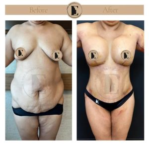 imgi_41_mommy-makeover-in-turkey-before-after-04-1024x1024.jpeg