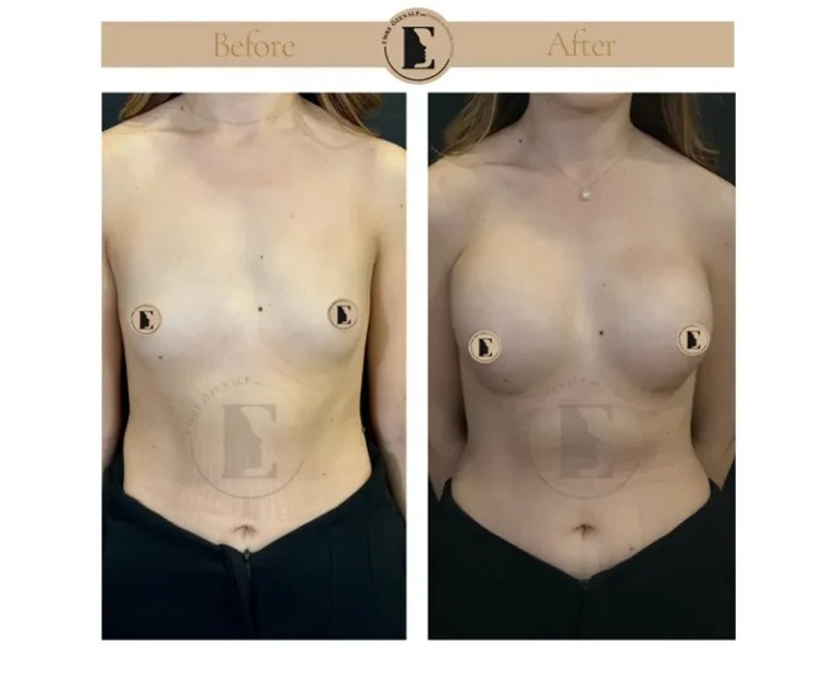 imgi_45_boob-job-breast-augmentation-in-turkey-before-after-01-768x624