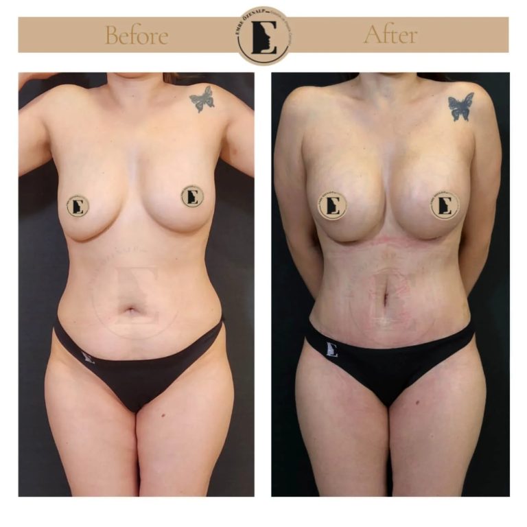 Before after photos of breast lift with implants Turkey