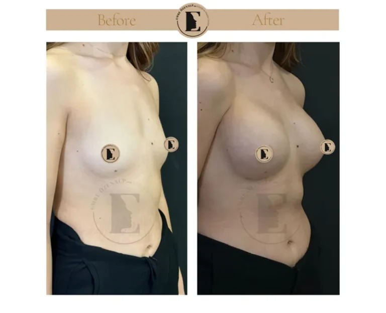 imgi_51_boob-job-breast-augmentation-in-turkey-before-after-08-768x624