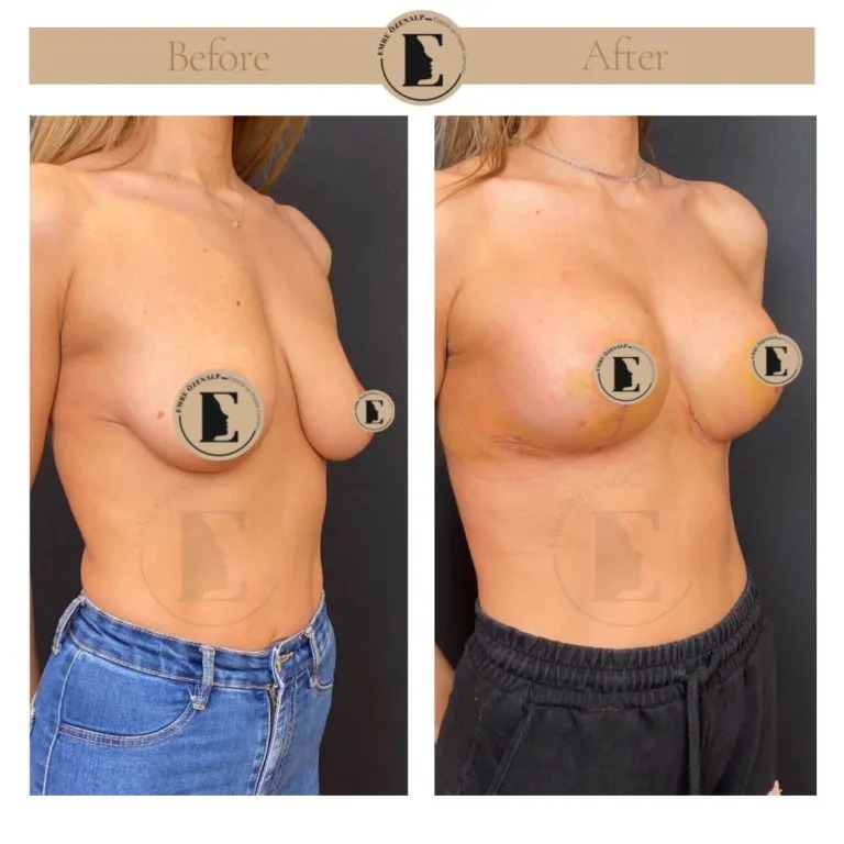 Breast lift Turkey before after showing improved shape