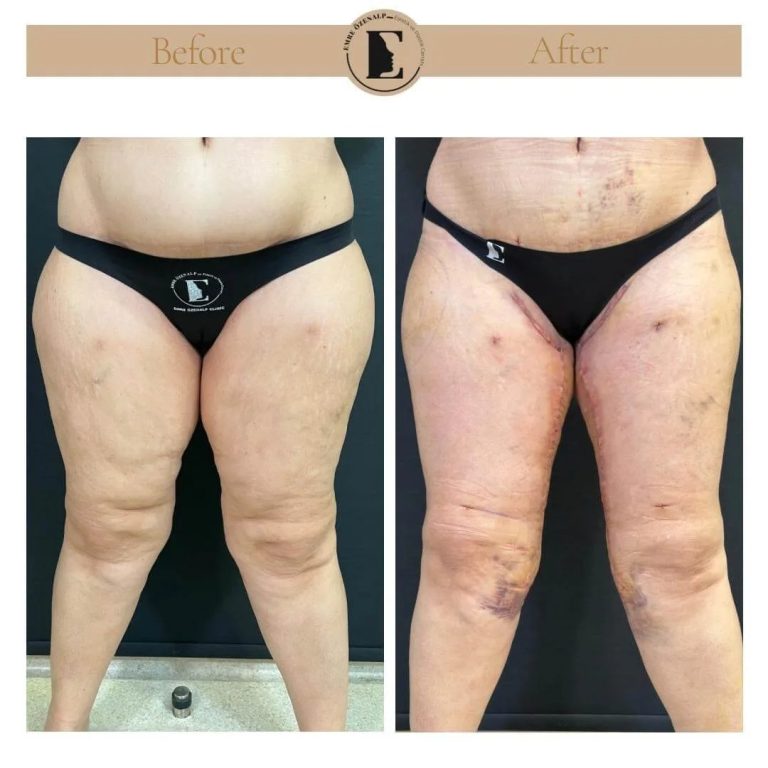 imgi_53_thigh-lift-in-Turkey-before-after-05.jpg