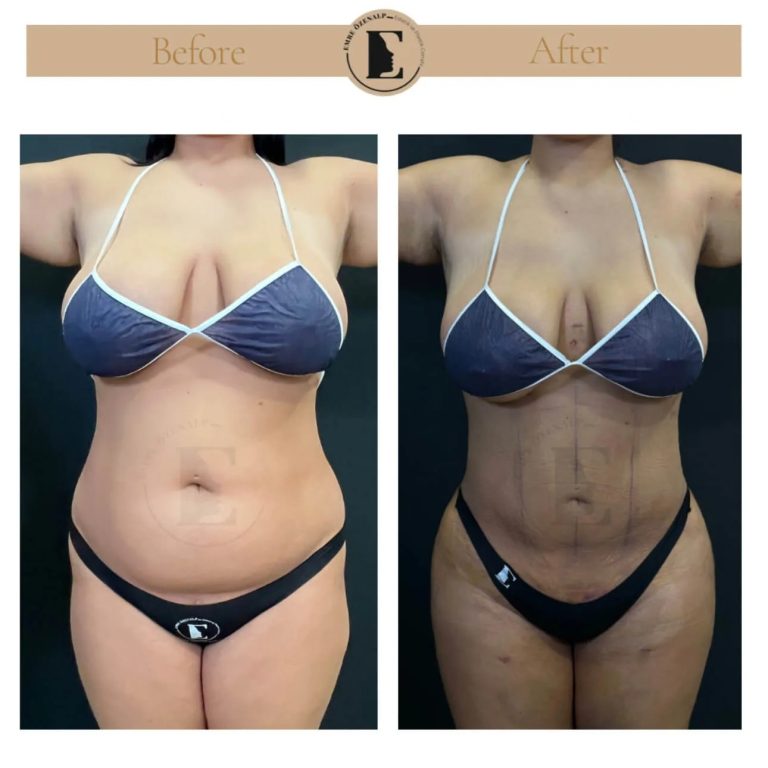 imgi_55_liposuction-before-after-in-turkey-results-02.jpeg