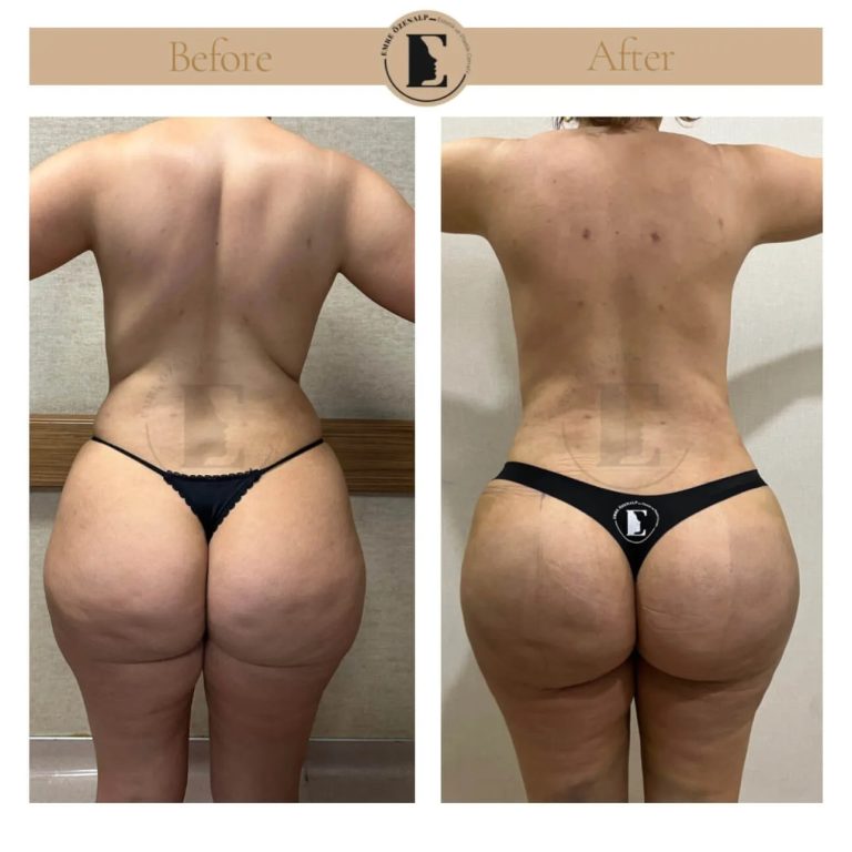 imgi_57_BBL-before-after-in-Turkey-23.jpeg