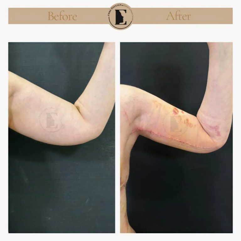 imgi_57_arm-lift-in-turkey-before-after-5.jpeg