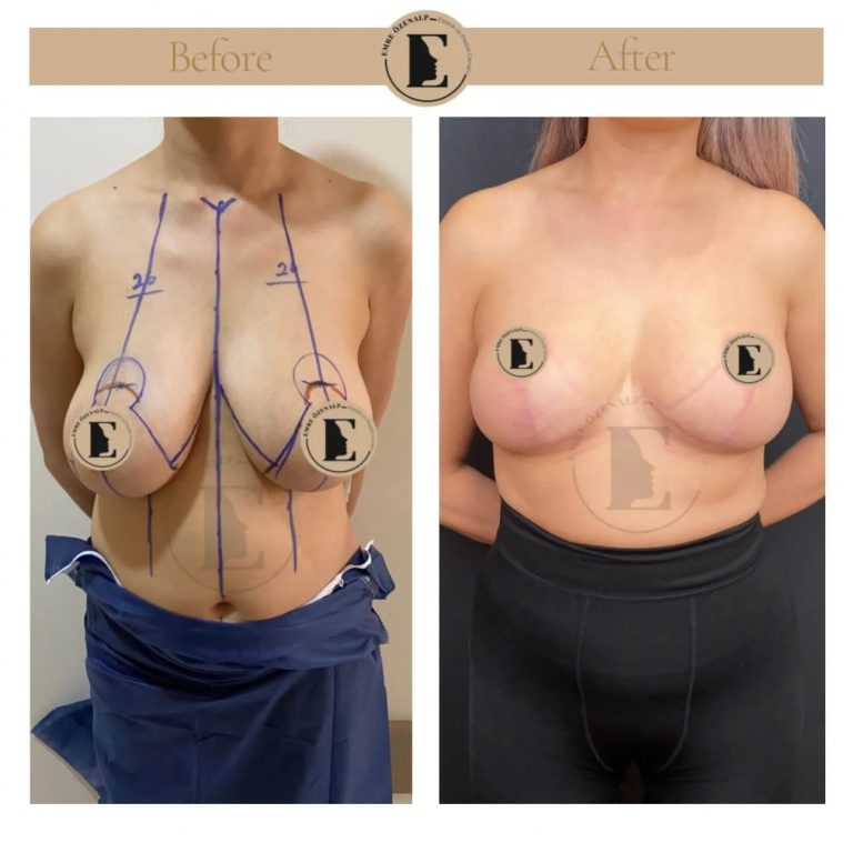 imgi_57_boob-reduction-in-turkey-before-after-10.jpg