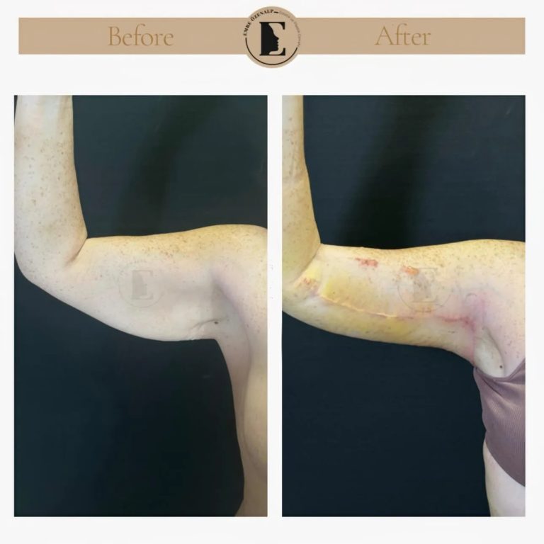 imgi_62_arm-lift-in-turkey-before-after-4.jpeg
