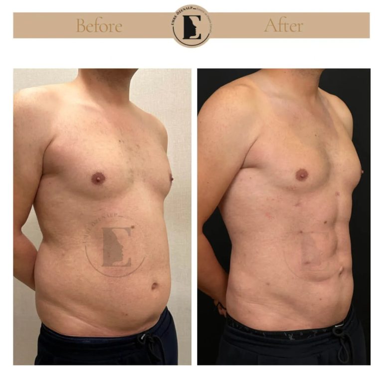 imgi_69_liposuction-hi-def-before-after-i-turkey-02.jpeg