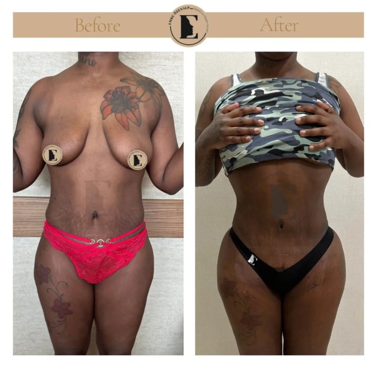 imgi_81_liposuction-before-after-in-turkey-results-17.jpg
