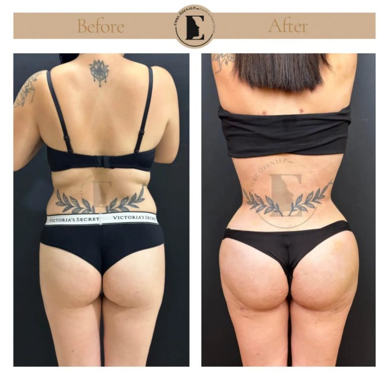 imgi_85_BBL-before-after-in-Turkey-03.jpeg