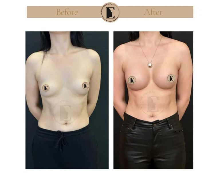 imgi_8_boob-job-breast-augmentation-in-turkey-before-after-02