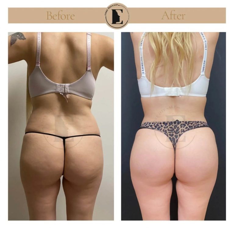 imgi_99_BBL-before-after-in-Turkey-05.jpeg