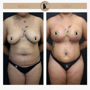 imgi_9_mommy-makeover-in-turkey-before-after-36-1024x1024.jpeg