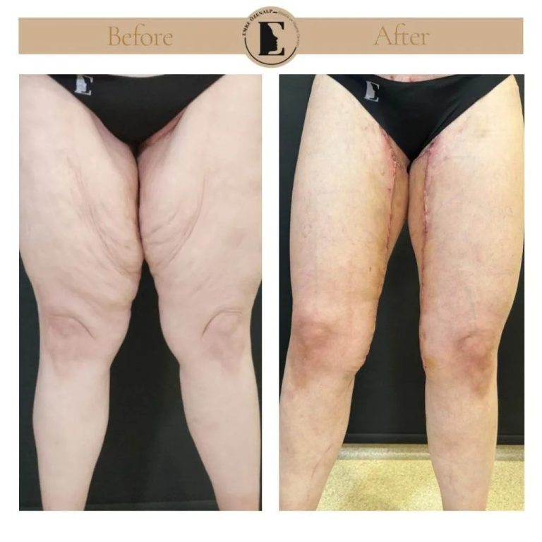 imgi_9_thigh-lift-in-Turkey-before-after-02-1024x1024.jpg