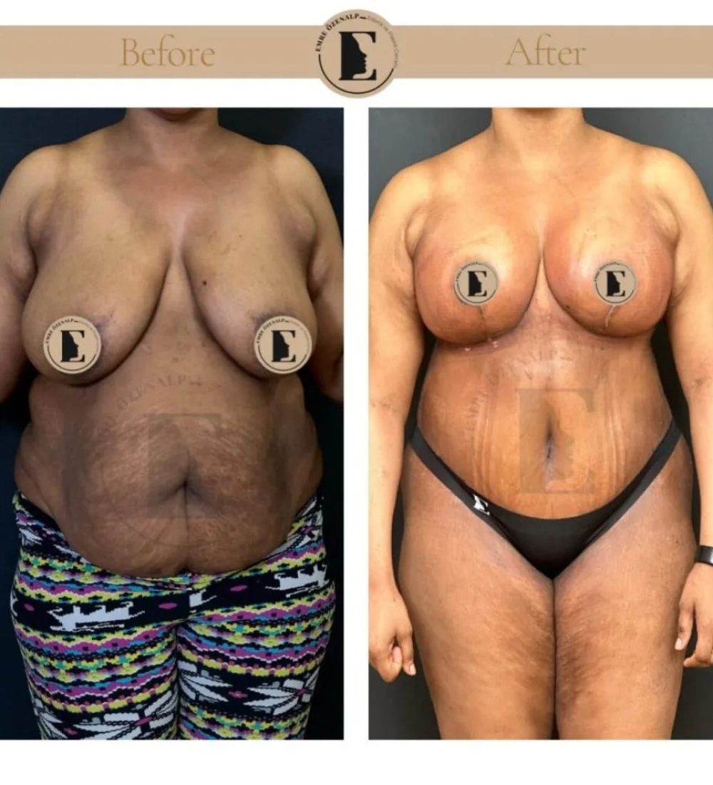 imgi_11_mommy-makeover-in-turkey-before-after-34-1024x1024.jpeg