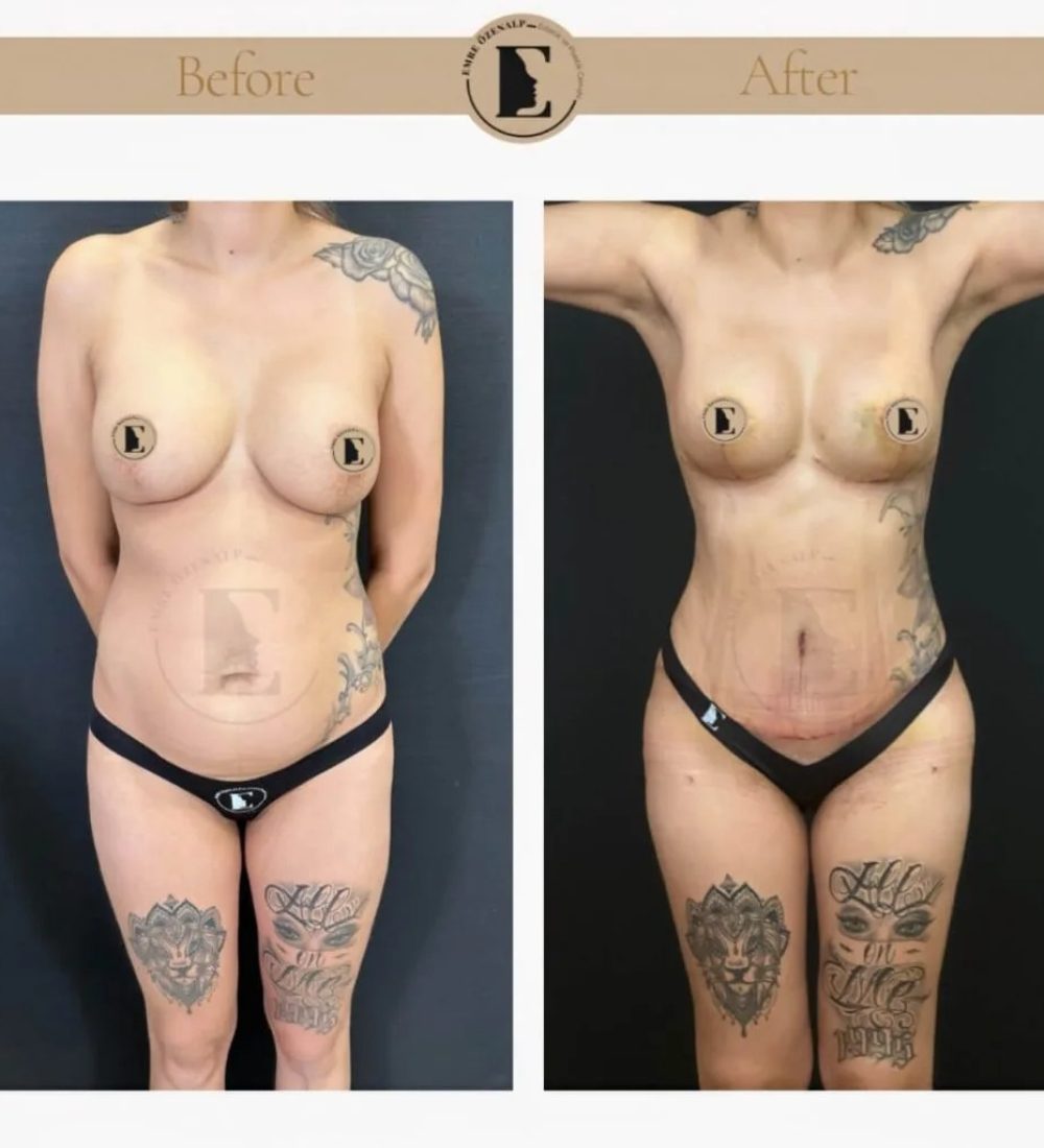 imgi_28_mommy-makeover-in-turkey-before-after-17-1024x1024.jpeg
