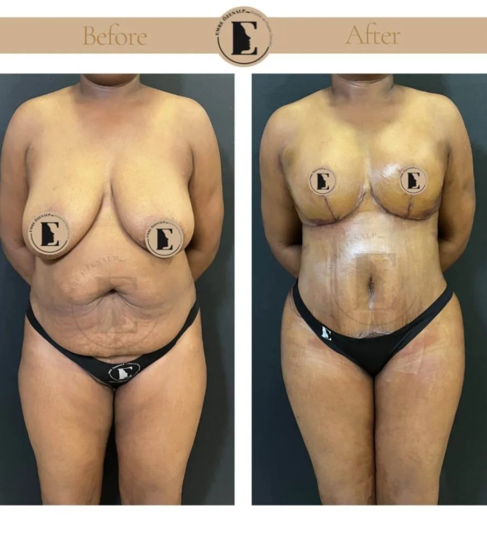 imgi_40_mommy-makeover-in-turkey-before-after-05-1024x1024.jpeg